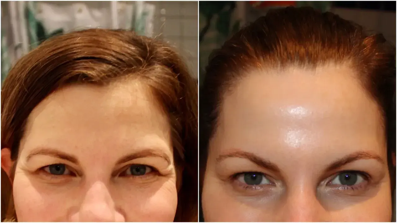 Före- och efterbilder visar hur man kan få bort bekymmersrynka utan botox. Pannan ser slätare ut på efterbilden.