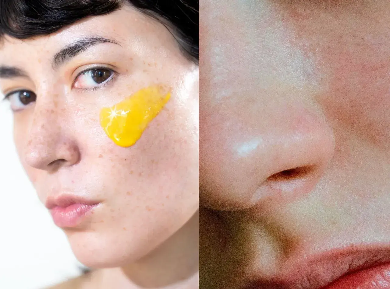 Nära bild på ansikte med gul kräm på kinden, möjligen för att behandla rosacea. Retinol kan vara en del av behandlingen.