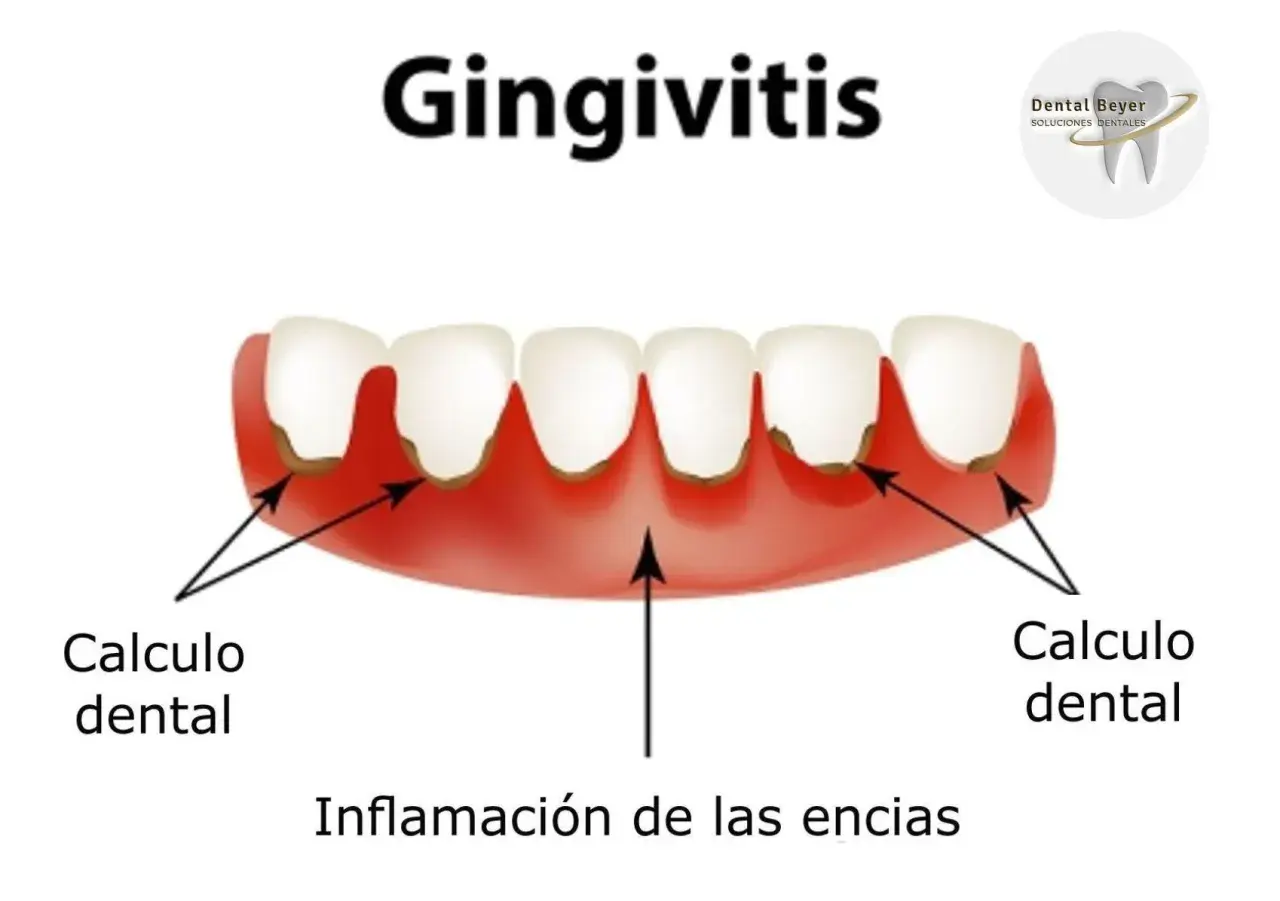 Encías inflamadas y con sarro, indicando gingivitis grave. Se observa cálculo dental y la inflamación de las encías.