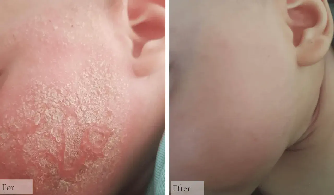 Före och efter-bilder som visar ett barns ansikte med svårt eksem bebis, som sedan läkt och blivit mjuk och fin.