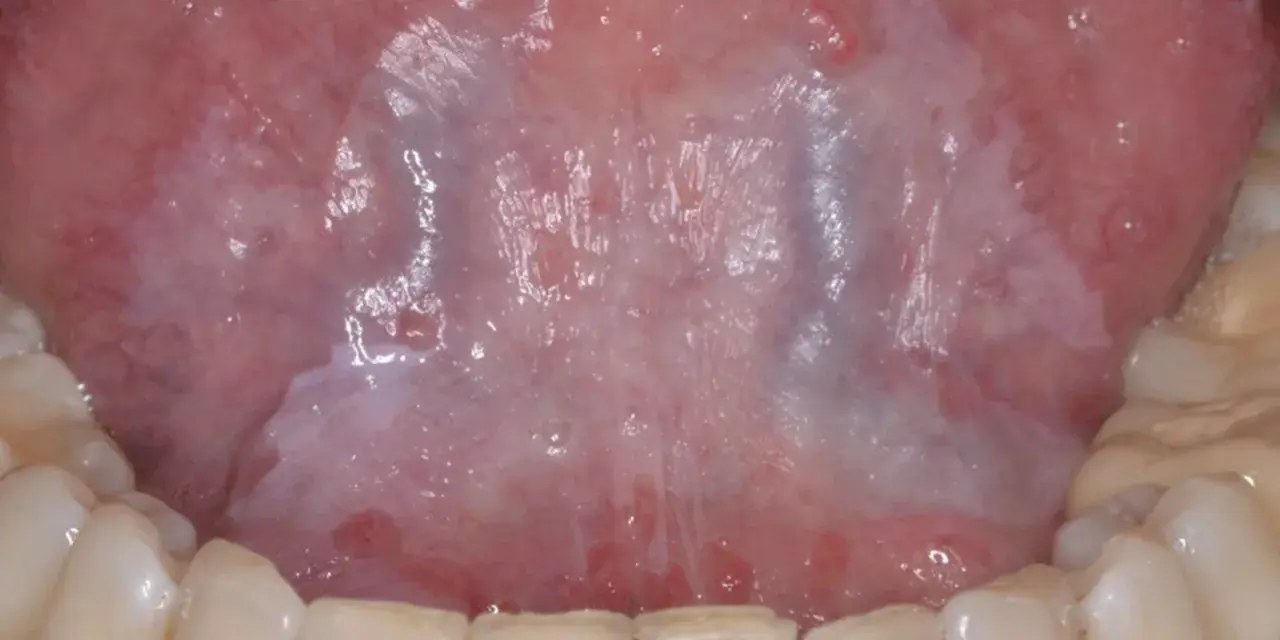 Vista detallada de la lengua mostrando áreas blanquecinas y rojizas, indicativas de leucoplasia en la lengua.