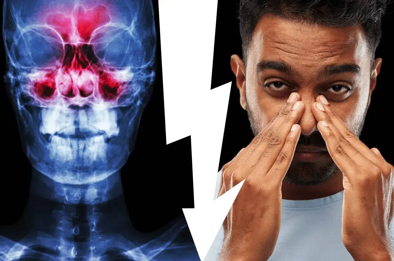 Radiografia del cranio che mostra l'anatomia del seno mascellare infiammato, accanto a un uomo che si tocca il naso per il dolore.