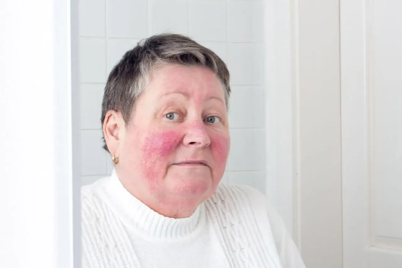 Kvinna med rodnad i ansiktet, troligen rosacea på kroppen.
