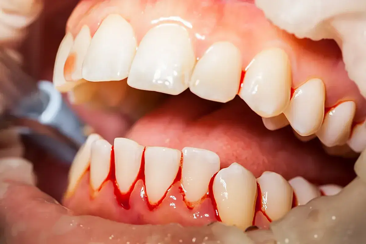 Encias inflamadas con sangrado alrededor de los dientes. Se observa un instrumento dental.