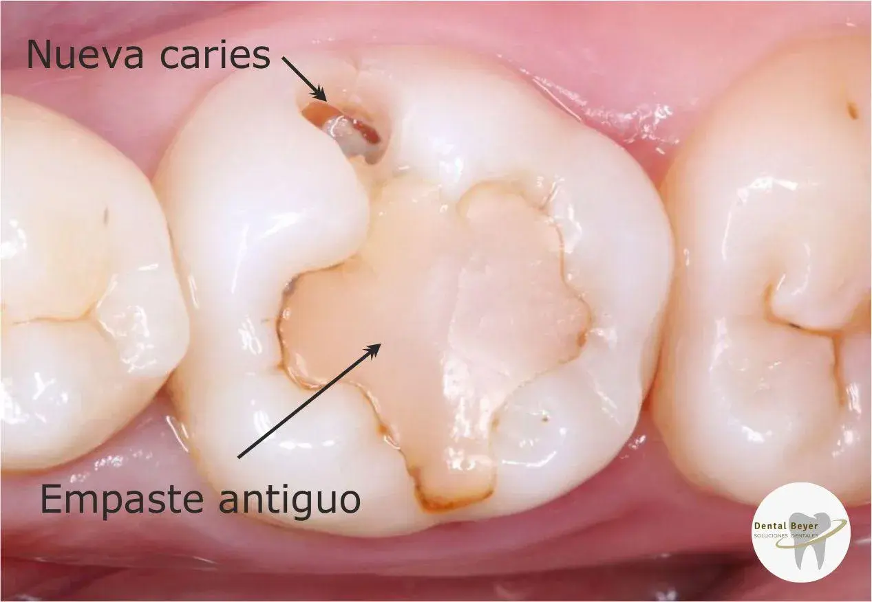 Diente con empaste antiguo y nueva caries. El empaste ha cedido, dejando espacio para la caries.