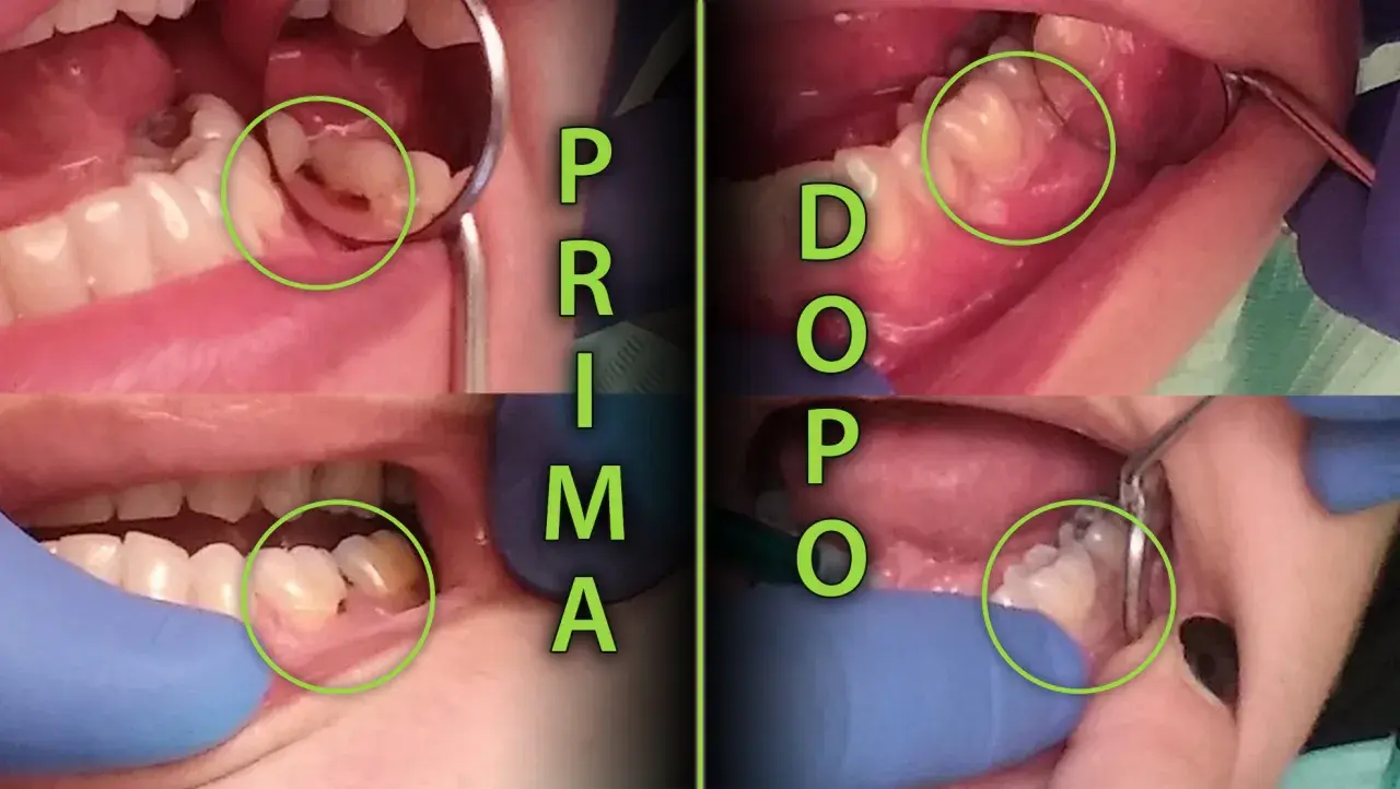 Prima e dopo il trattamento di una carie al colletto dentale. La carie è visibile in verde.