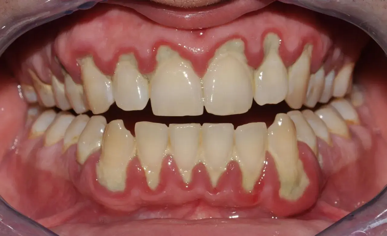 Gengive infiammate e retratte, con accumuli giallastri alla base dei denti, mostrano perché vengono le placche e i problemi che causano.