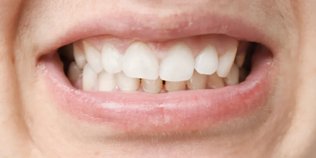Primer plano de una boca con dientes blancos y labios rosados. Se observa una mordida profunda, donde los dientes superiores cubren significativamente los inferiores.