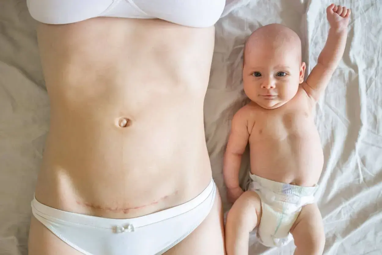 Po cesarskim cięciu, które może być związane z wadą wzroku a porodem, mama i dziecko leżą obok siebie.
