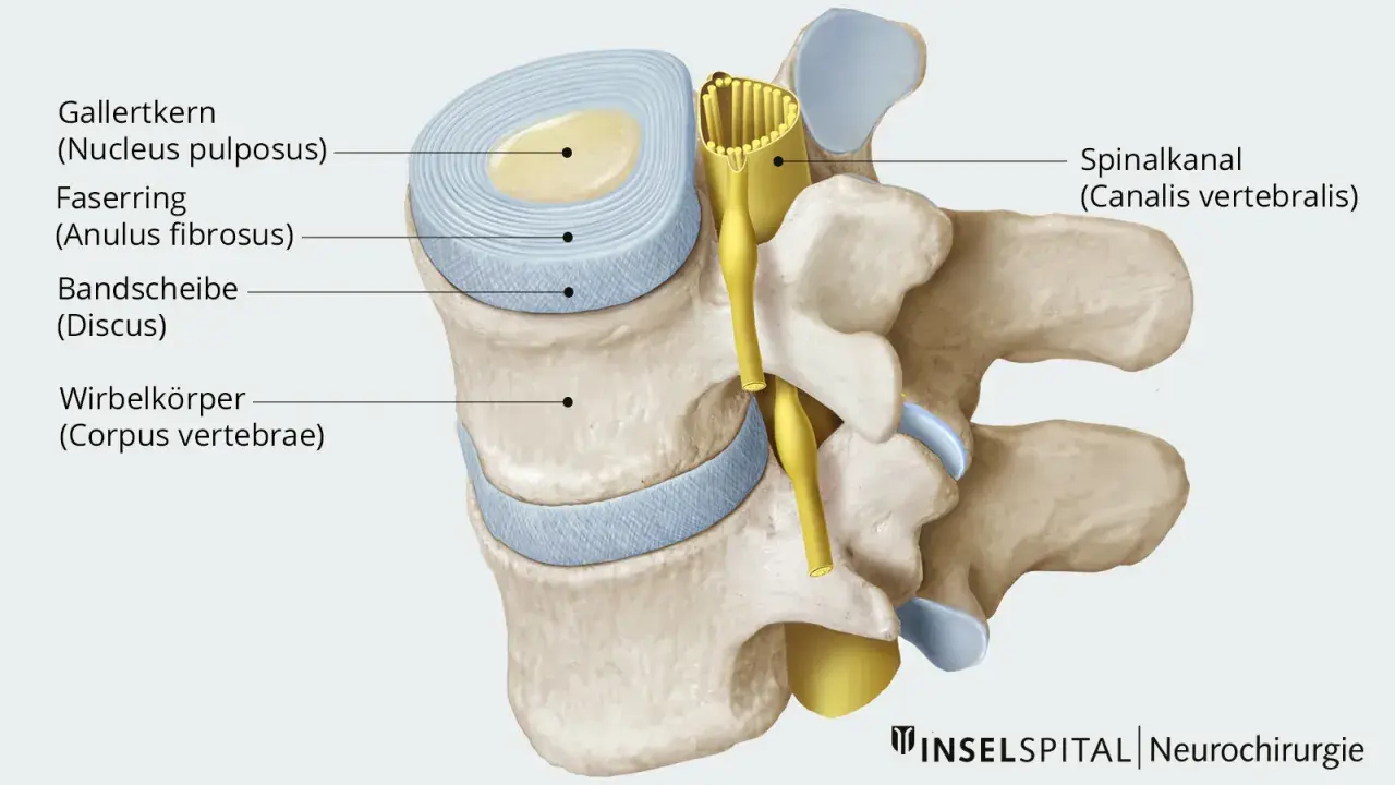 Querschnitt einer Bandscheibe mit Gallertkern und Faserring, die auf einen Spinalkanal drückt. Dies zeigt eine breitbasige Bandscheibenprotrusion.