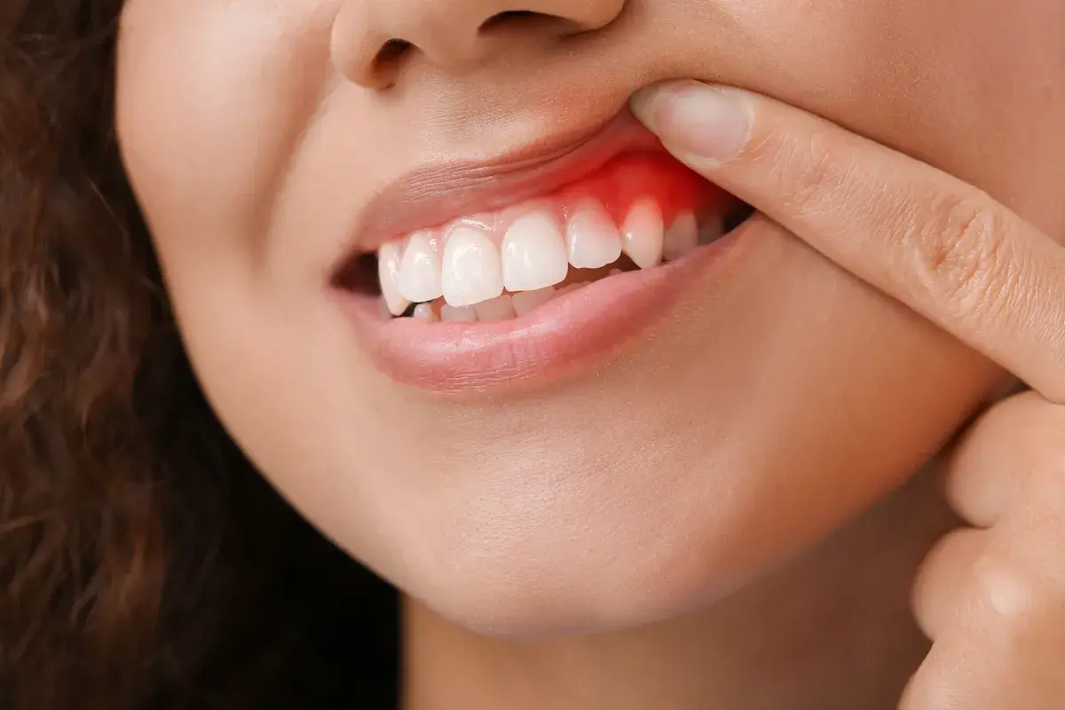 Dito indice indica un'infiammazione gengive, con arrossamento e gonfiore visibili attorno ai denti.