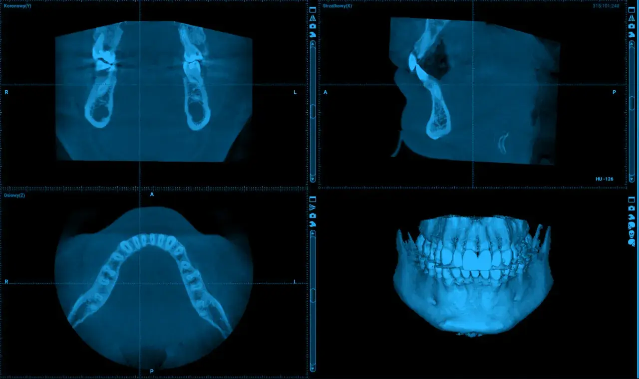 Trzy widoki tomografii komputerowej szczęki i żuchwy. Widok osiowy pokazuje łuk zębowy. Ile kanałów ma 7 zębów? To pytanie dla dentysty.