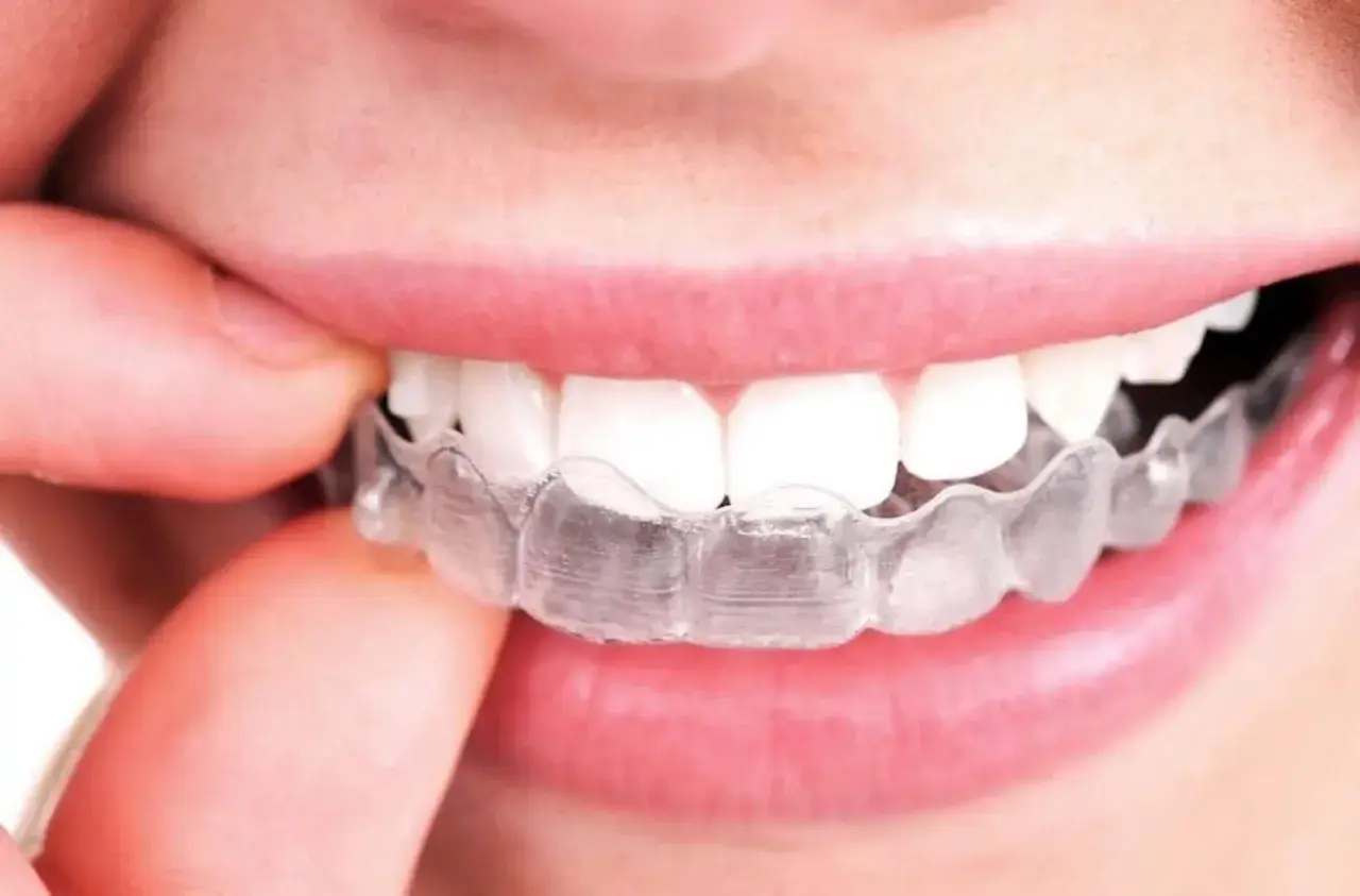 Una persona se ajusta un alineador transparente. Aunque el tratamiento es discreto, a veces el **invisalign duele** al principio.