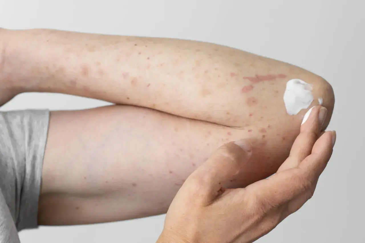Arm mit roten Flecken und Creme, deutet auf einen **pollenallergie ausschlag** hin.