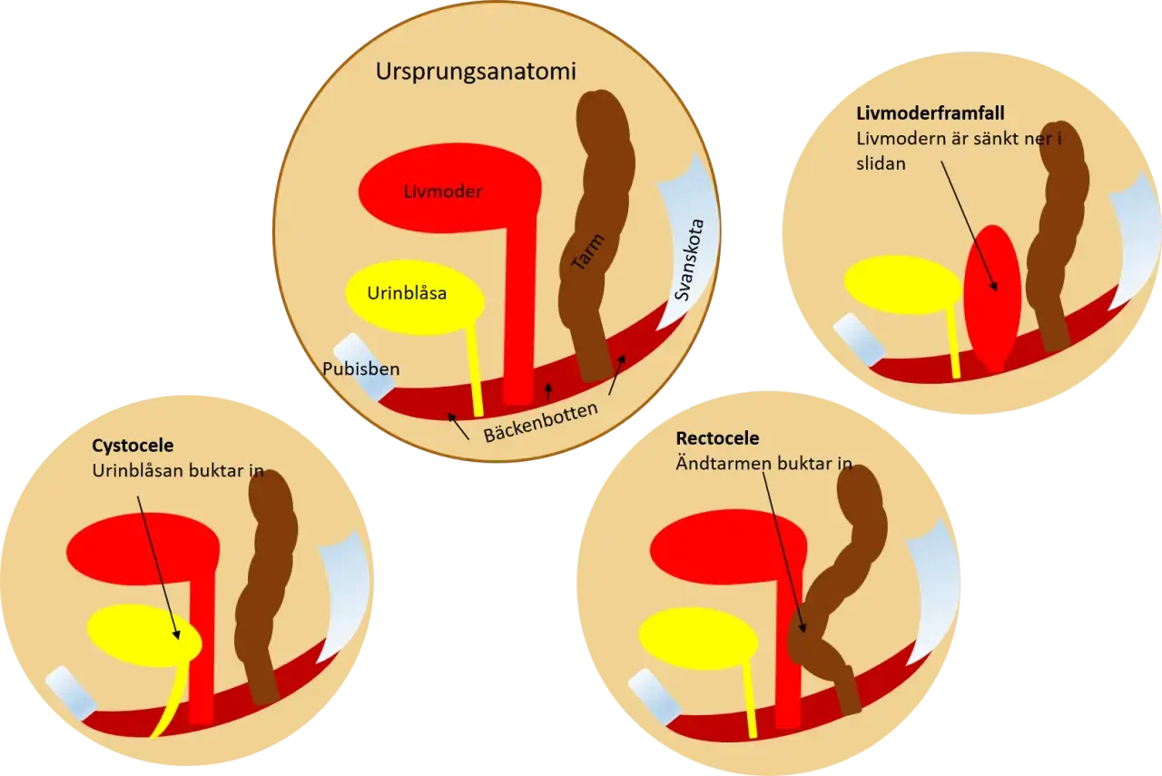 Illustrationer visar hur livmoderframfall, cystocele och rektosele ser ut.