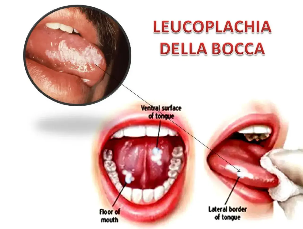 Leucoplachia della bocca: lesioni biancastre su lingua e pavimento orale. Non è una malattia che porta alla morte, ma un segnale da non sottovalutare.