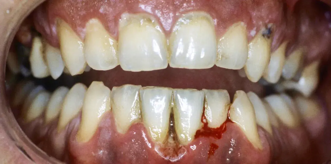 Gengive infiammate e sanguinanti, denti ingialliti e con tartaro, un quadro di dolore alle gengive e denti che necessita cure.