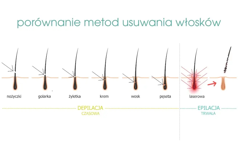 Elektroepilacja: Jedyna trwała depilacja dla każdego włosa?