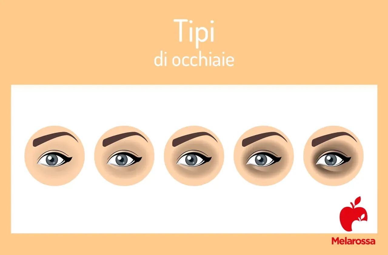 Cinque tipi di occhiaie nere, da leggere a profonde, illustrate con occhi stilizzati.