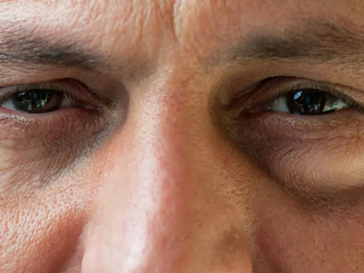 Nahaufnahme eines Gesichts mit einem leicht geschwollenen Auge. Was tun bei einem Auge angeschwollen? Hier sind Tipps.