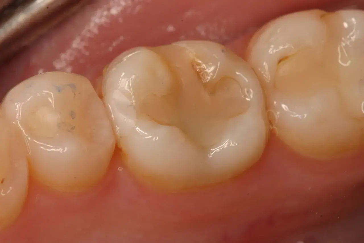 Detalle de un empaste mal hecho en un diente, con irregularidades y zonas de coloración amarillenta.