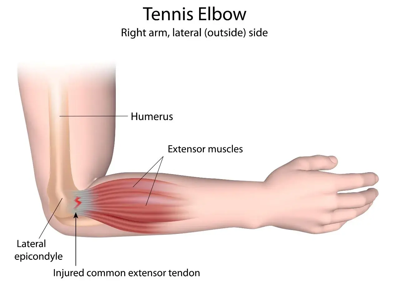 Illustration zeigt den rechten Arm bei Tennisarm. Schmerzen entstehen durch verletzte Sehnen am seitlichen Ellbogenknochen.