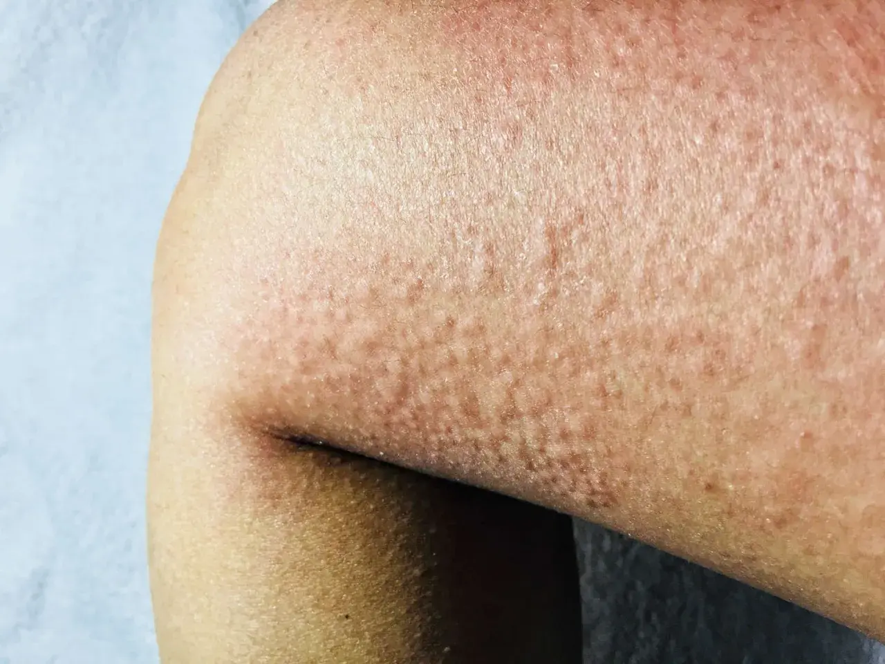 Pelle arrossata con piccoli pomfi, tipica dell'orticaria. Scopri come curarla.