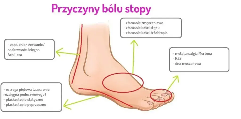 Ból stopy: Kiedy to alarm? Poznaj przyczyny i objawy