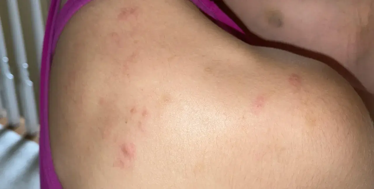 Piel con marcas rojas y elevadas, indicando posible acne en la espalda.