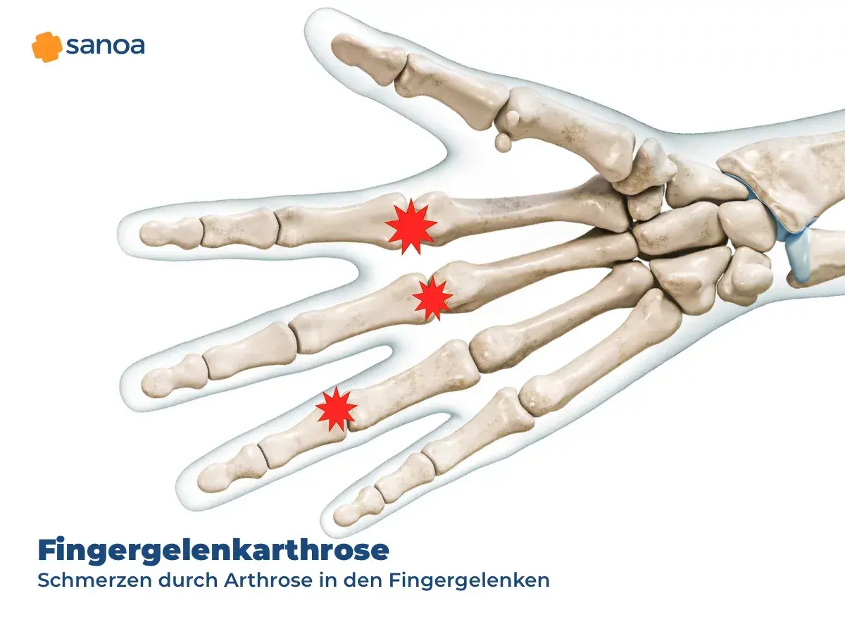 Illustration der Knochen der Hand, die Schmerzen durch Arthrose in den Fingergelenken zeigt.