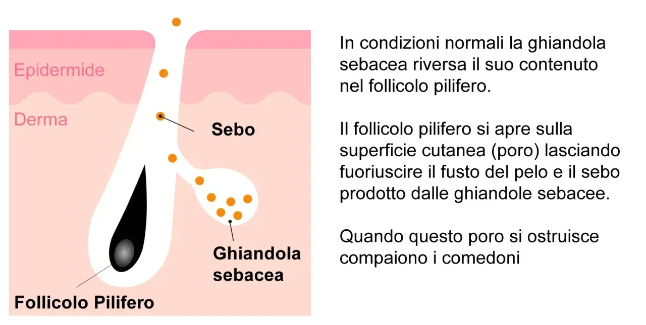 Diagramma della pelle che mostra un follicolo pilifero e una ghiandola sebacea. Punti neri giganti indicano l'accumulo di sebo.