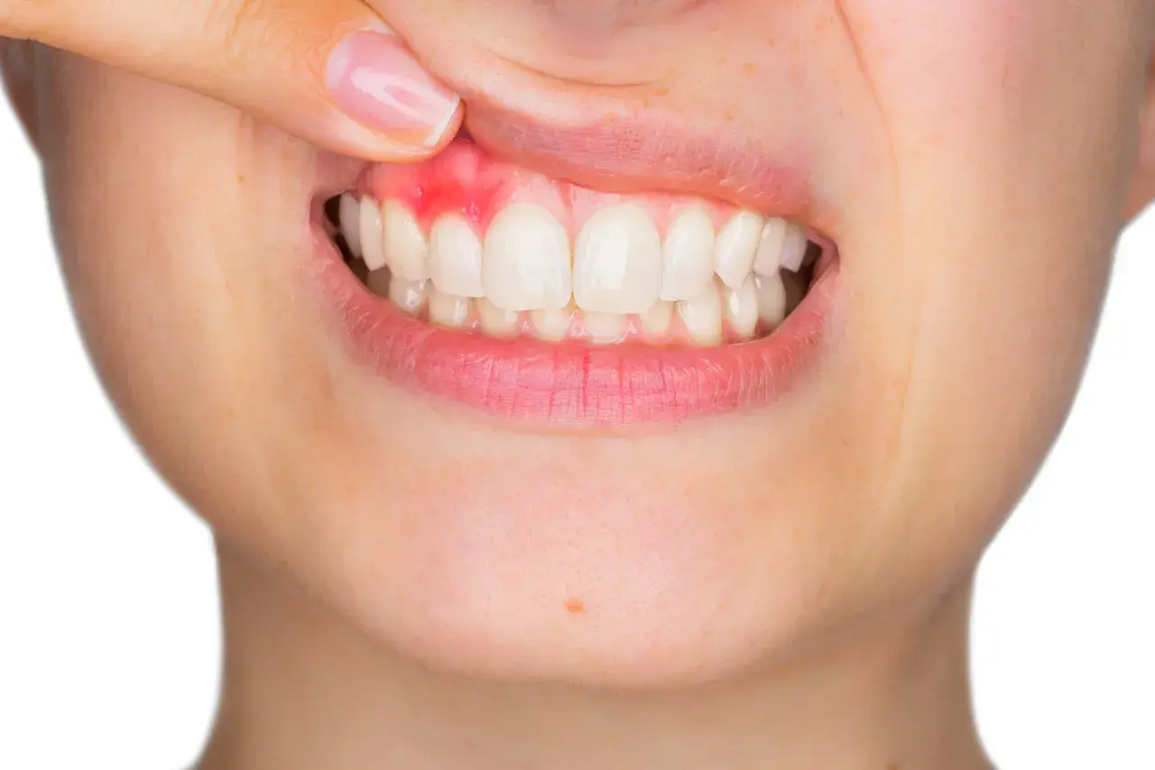 Dente con gengiva arrossata e gonfia, segno di infiammazione. La piorrea è curabile con cure adeguate.