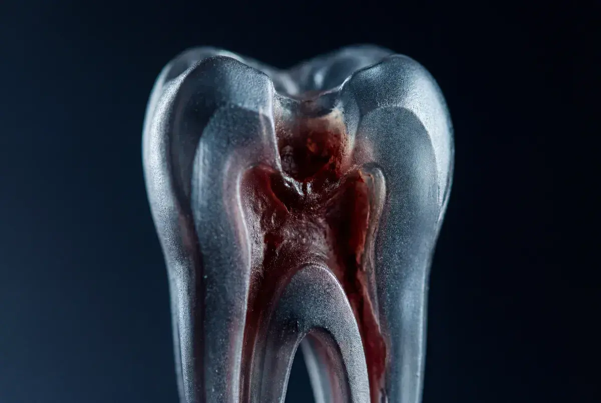 Modello di dente con polpa infiammata, che illustra i sintomi di un ascesso dentale.