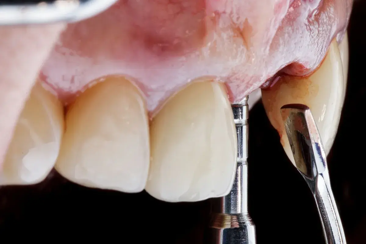 Dettaglio di un impianto dentale provvisorio in fase di posizionamento, con strumenti dentistici e denti in primo piano.