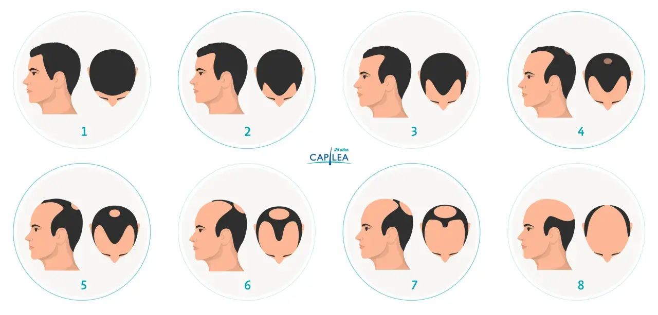 Escala de Norwood que muestra la progresión de la pérdida de cabello, desde una densidad capilar completa hasta la calvicie.