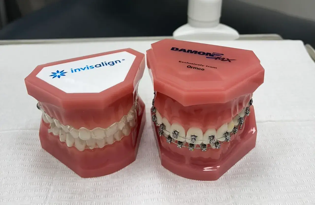 Modele szczęk pokazujące Invisalign i tradycyjny aparat na wadę zgryzu.