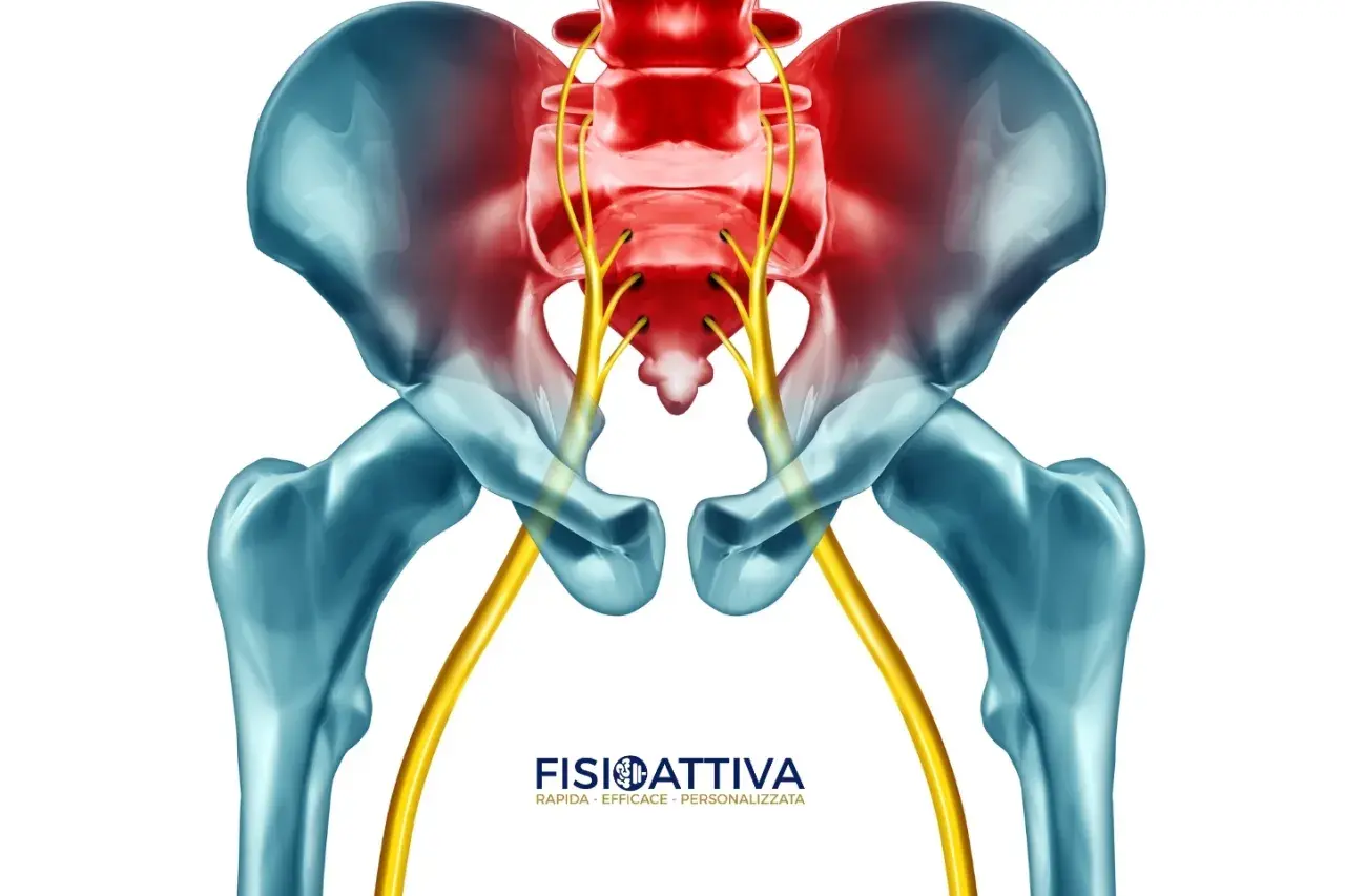 Dolore al nervo sciatico che causa scosse gamba sinistra. Anatomia del bacino e nervi evidenziati in rosso.