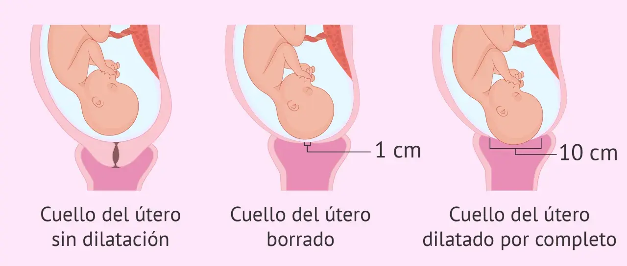 Ilustración muestra la dilatación del cuello uterino durante el parto: sin dilatación, borrado y dilatado por completo (10 cm).
