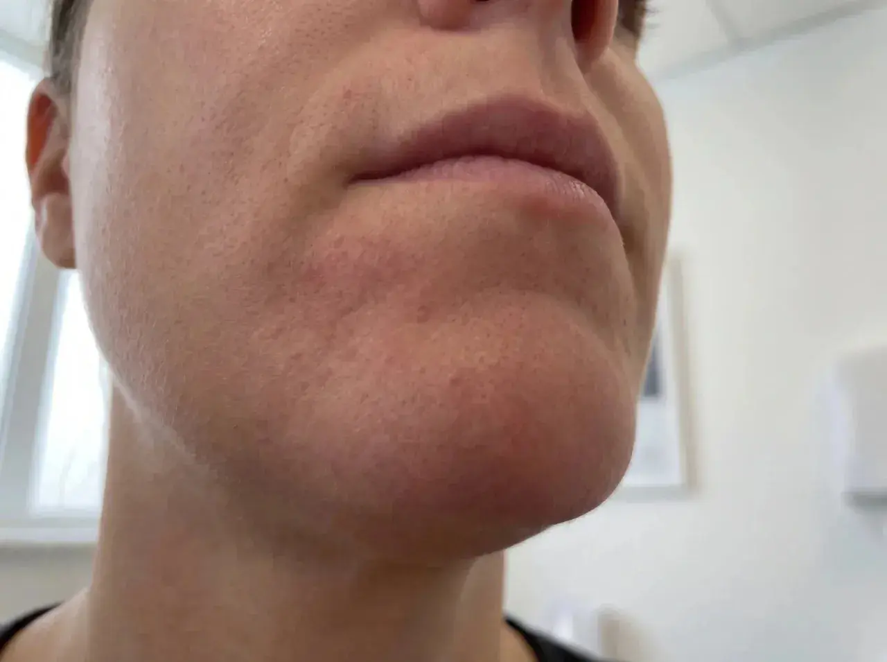 Närbild på en persons haka och mun. Huden runt munnen är röd och irriterad, vilket kan vara tecken på perioral dermatit, ibland kopplat till klimakteriet.
