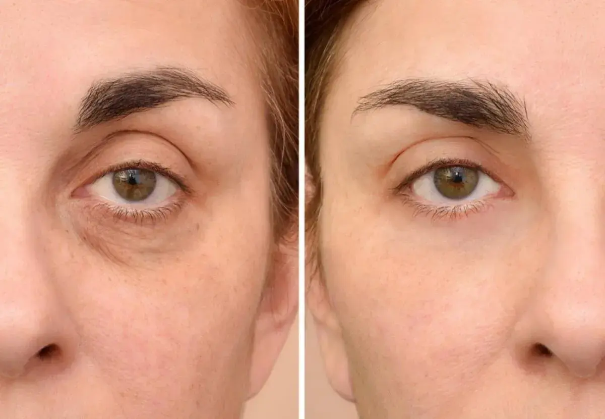 Antes y después de un tratamiento para quitar ojeras oscuras. La piel luce más luminosa y descansada.