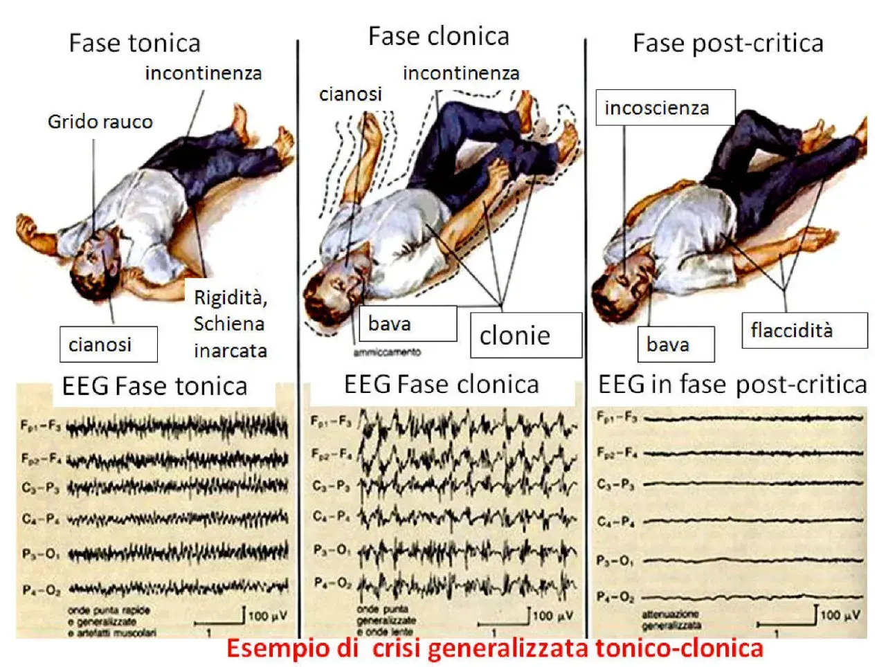 Illustrazione delle fasi di una crisi epilettica tonico-clonica: rigidità, cianosi, incontinenza, bava, clonie, incoscienza. Sintomi premonitori e EEG.