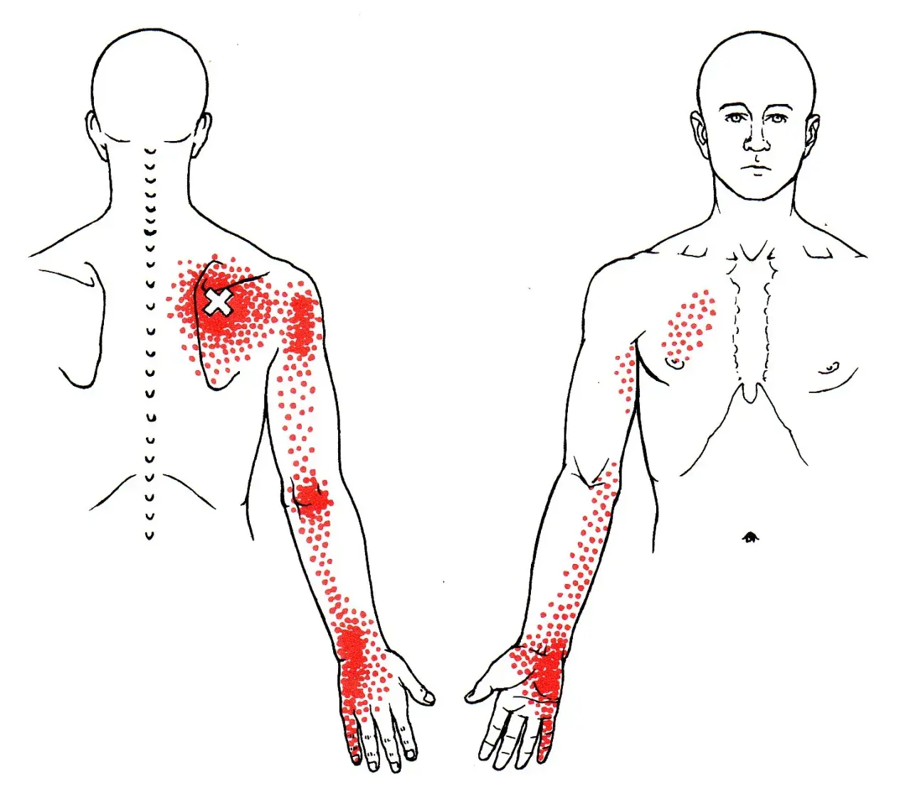 Dolor serrato posterior superior: Alivio y prevención efectiva