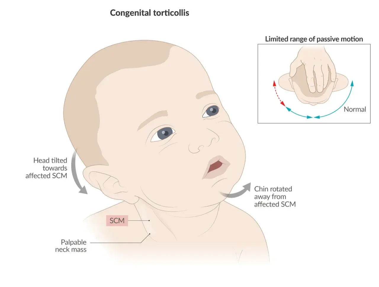 Baby mit angeborenem Schiefhals (torticollis spasticus). Kopf zur betroffenen SCM geneigt, Kinn weggedreht. Eingeschränkte Beweglichkeit.