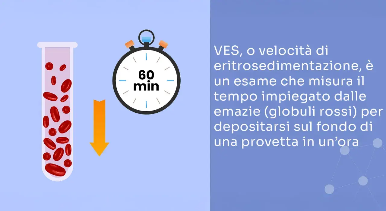 Provetta con globuli rossi e cronometro indicano un esame VES, utile per rilevare un'infezione ai denti o altre infiammazioni.