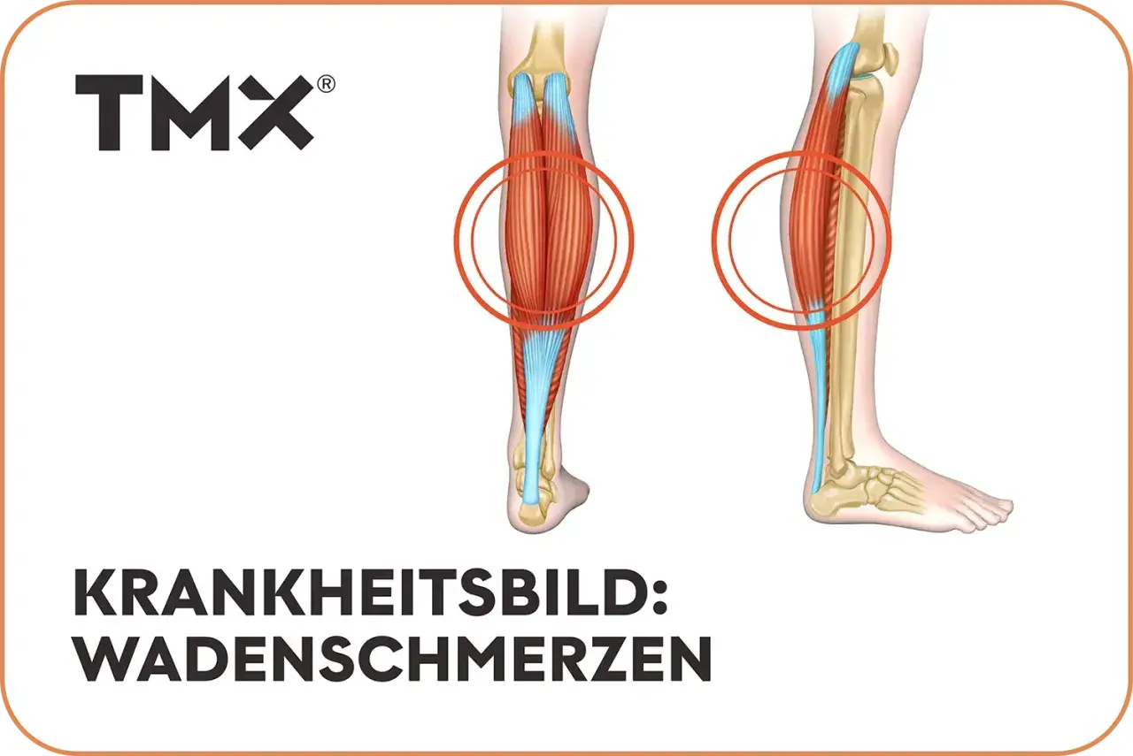Anatomische Darstellung der Beinmuskulatur mit Hervorhebung der Wadenmuskeln. Rote Kreise markieren Bereiche, die auf **Schmerzen in der Wade** hinweisen könnten.