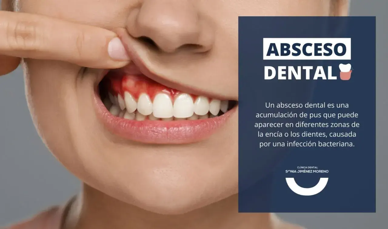 Primer plano de una boca mostrando encías rojas e inflamadas, indicativo de un absceso en la encía. Texto informativo sobre abscesos dentales.