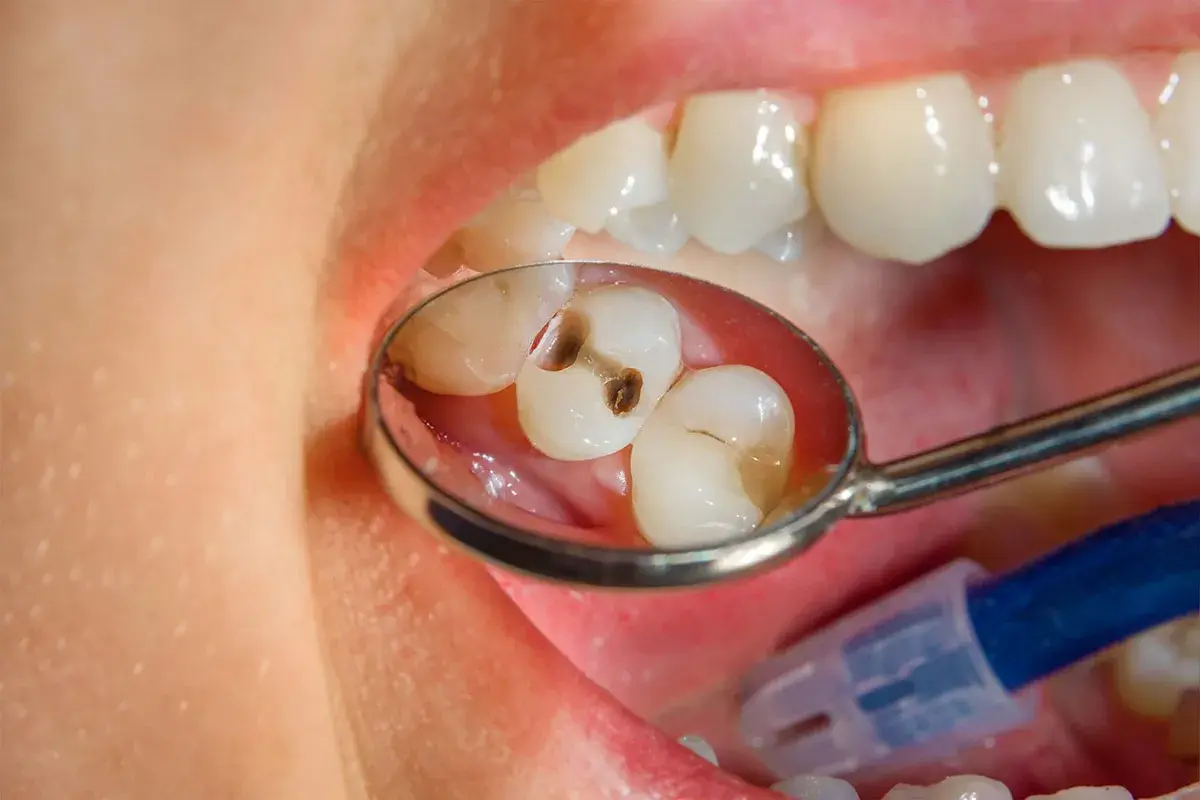 Primo piano di un dente bucato, visibile in uno specchietto dentale. La carie ha creato una cavità scura.