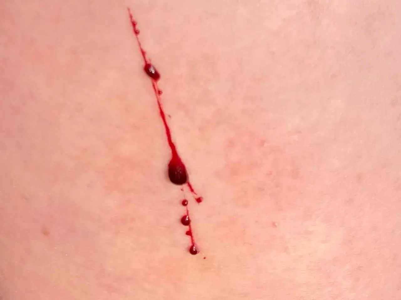 Rote Kratzer auf der Haut ohne Grund, mit Blutstropfen, die langsam herunterlaufen.