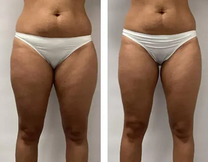 Endermologia: Kiedy efekty? Po 3 sesjach już widać! Pełna przemiana