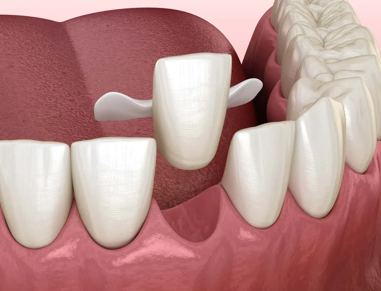 Una corona dentale bianca si posiziona su un dente preparato, pronta a proteggere un dente che si stacca.